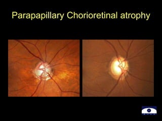 Parapapillary Chorioretinal atrophy
 