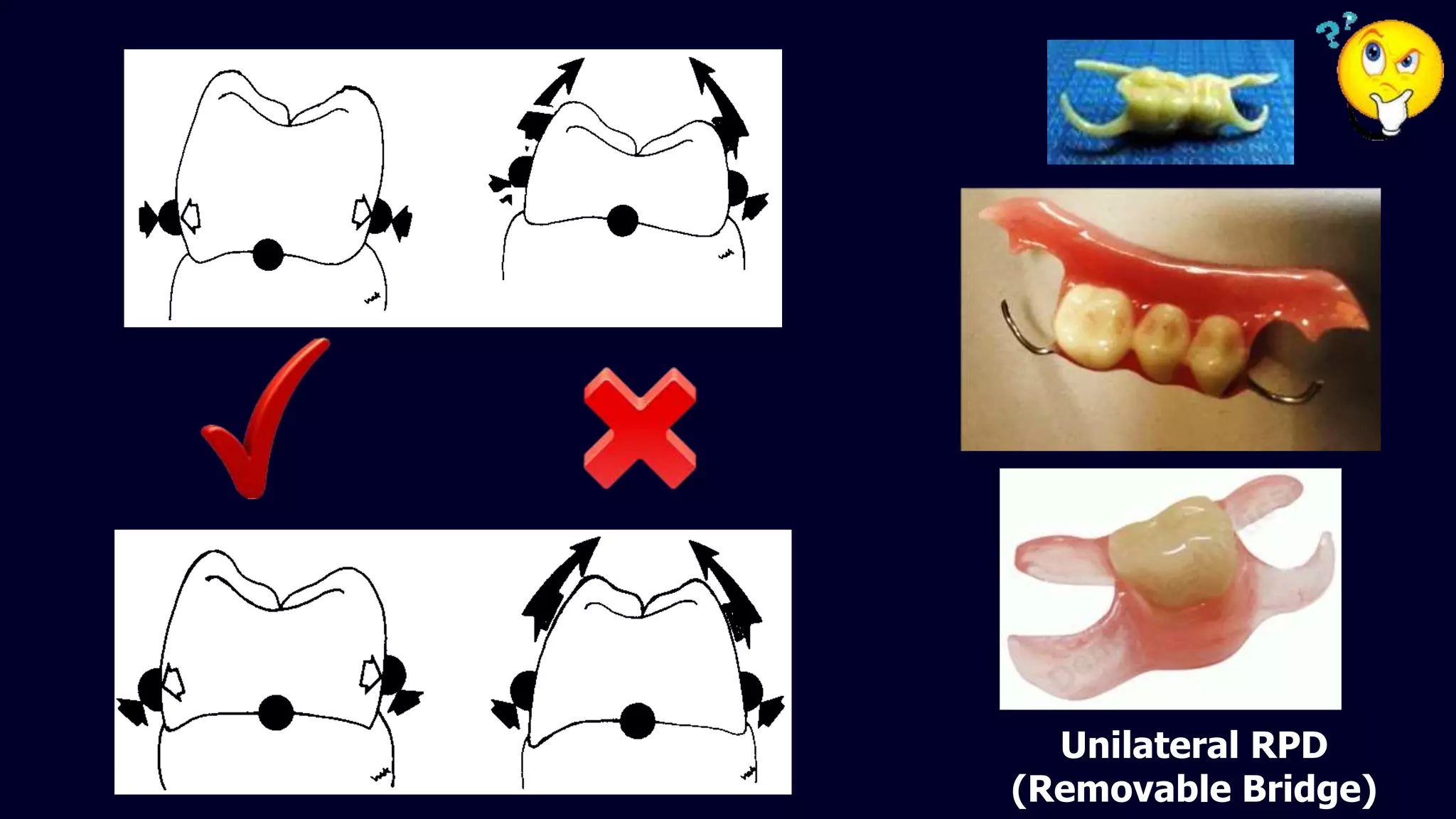 Other forms of removable partial denture | PPTX