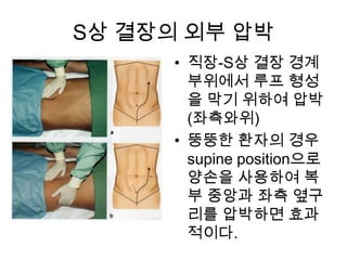 S상 결장의 외부 압박
• 직장-S상 결장 경계
부위에서 루프 형성
을 막기 위하여 압박
(좌측와위)
• 뚱뚱한 환자의 경우
supine position으로
양손을 사용하여 복
부 중앙과 좌측 옆구
리를 압박하면 효과
적이다.

 
