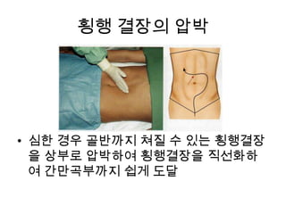 횡행 결장의 압박

• 심한 경우 골반까지 쳐질 수 있는 횡행결장
을 상부로 압박하여 횡행결장을 직선화하
여 간만곡부까지 쉽게 도달

 