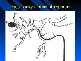 Эндоваскулярная обтурацияЭндоваскулярная обтурация
 