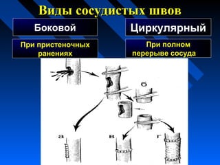 Виды сосудистых швовВиды сосудистых швов
Боковой Циркулярный
При пристеночных
ранениях
При полном
перерыве сосуда
 