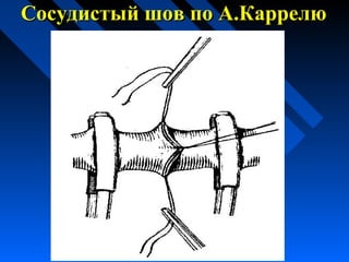Сосудистый шов по А.КаррелюСосудистый шов по А.Каррелю
 