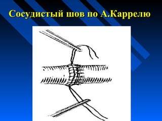 Сосудистый шов по А.КаррелюСосудистый шов по А.Каррелю
 