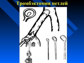 Тромбэктомия петлейТромбэктомия петлей
 