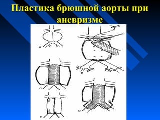 Пластика брюшной аорты приПластика брюшной аорты при
аневризмеаневризме
 
