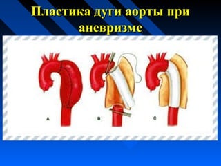 Пластика дуги аорты приПластика дуги аорты при
аневризмеаневризме
 