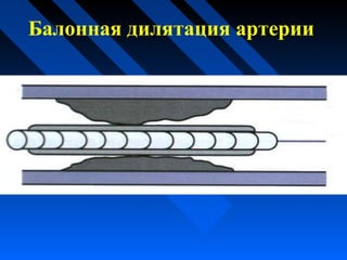 Балонная дилятация артерии
 