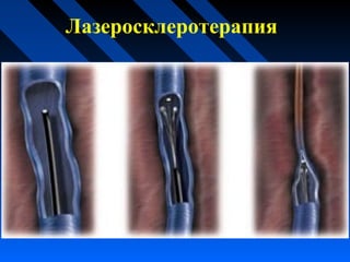 Лазеросклеротерапия
 