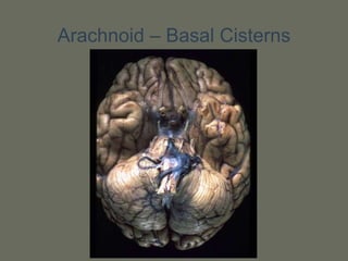 Arachnoid – Basal Cisterns
 