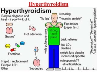 Hyperthyroidism
 