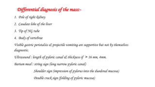Differential diagnosis of the mass:-
1. Pole of right kidney
2. Caudate lobe of the liver
3. Tip of NG tube
4. Body of vertebrae
Visible gastric peristalsis & projectile vomiting are supportive but not by themselves
diagnostic.
Ultrasound : length of pyloric canal & thickness if > 16 mm, 4mm.
Barium meal : string sign (long narrow pyloric canal)
Shoulder sign (impression of pylorus into the duodenal mucosa)
Double crack sign (folding of pyloric mucosa)
 
