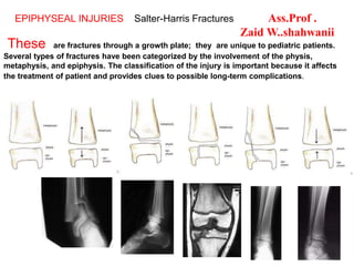 These are fractures through a growth plate; they are unique to pediatric patients.
Several types of fractures have been categorized by the involvement of the physis,
metaphysis, and epiphysis. The classification of the injury is important because it affects
the treatment of patient and provides clues to possible long-term complications.
EPIPHYSEAL INJURIES Salter-Harris Fractures Ass.Prof .
Zaid W..shahwanii
 