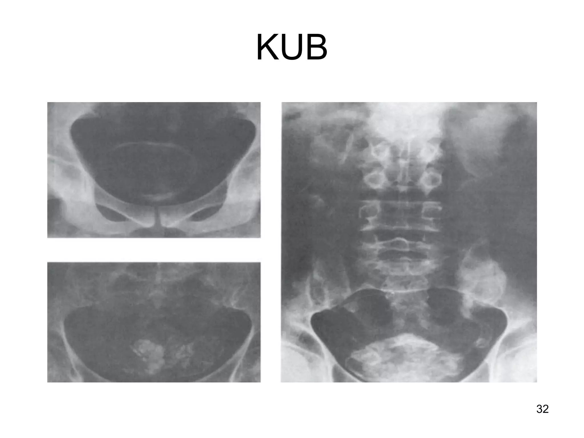 KUB
32
 