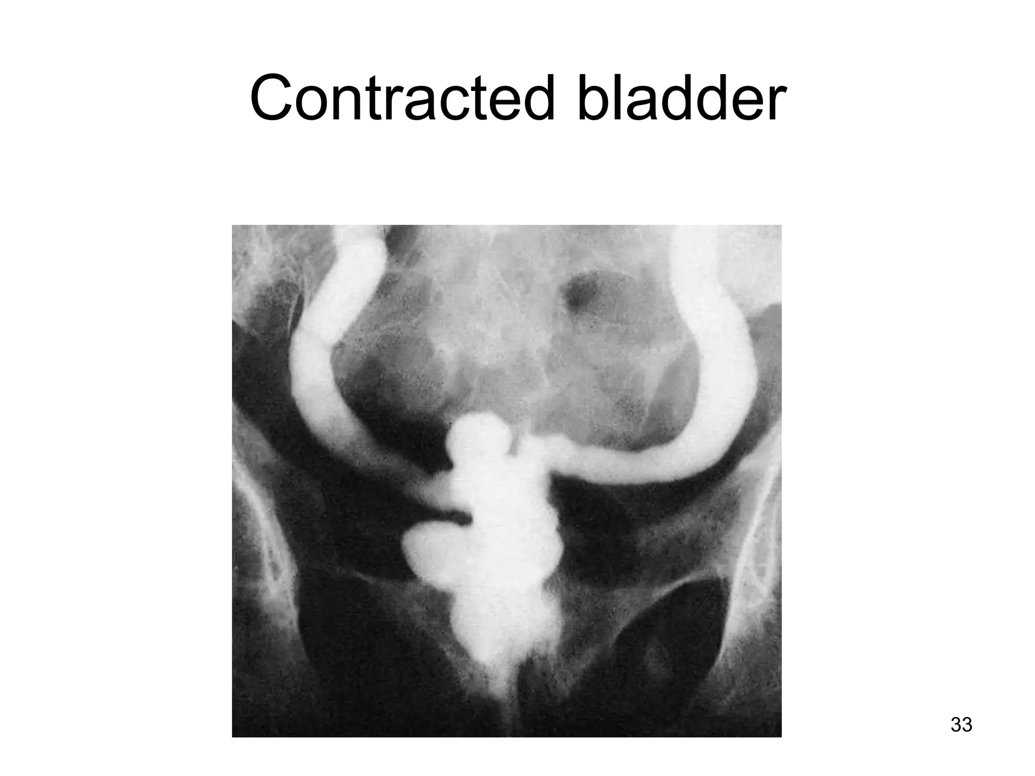Contracted bladder
33
 