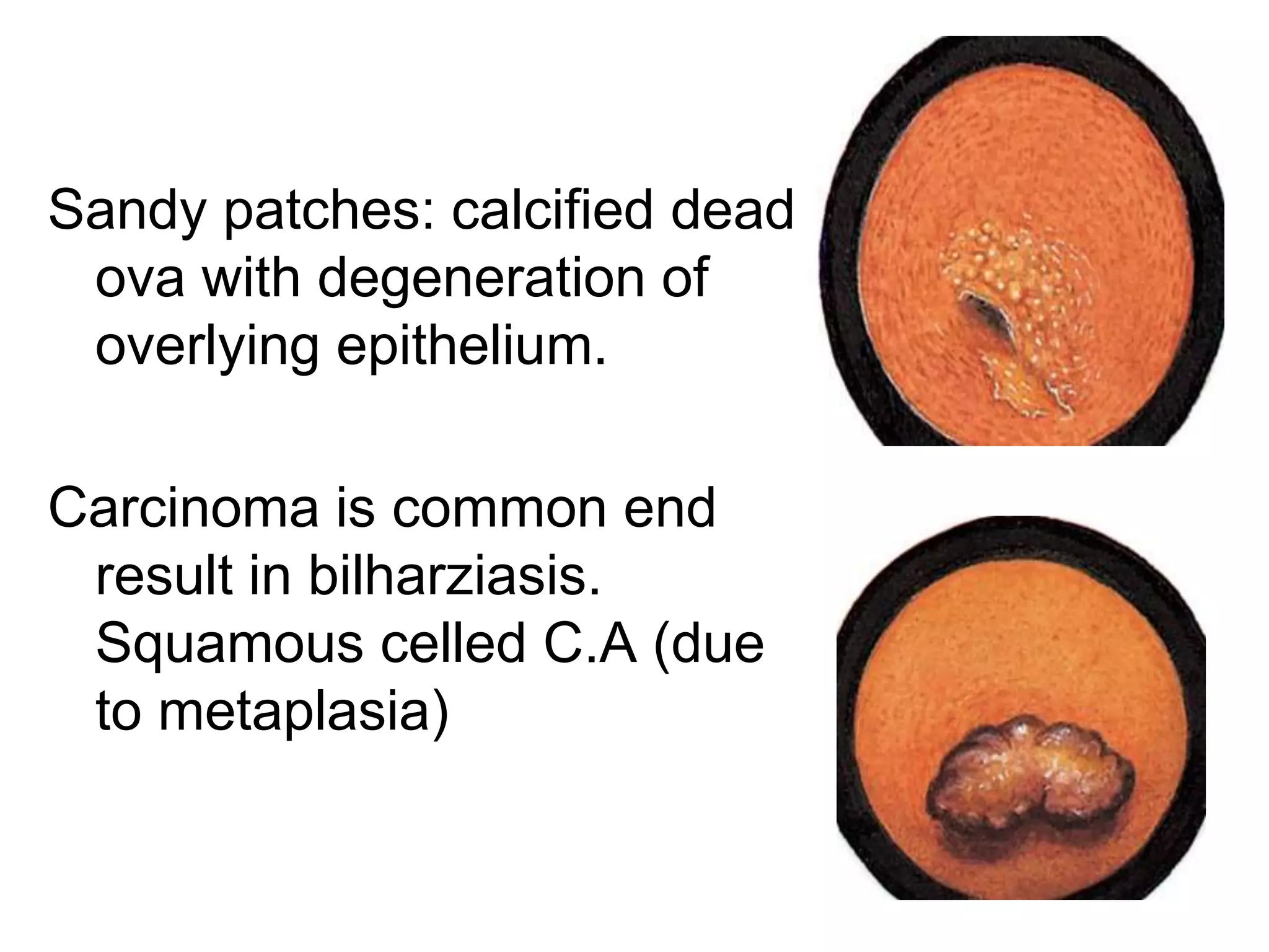 Sandy patches: calcified dead
ova with degeneration of
overlying epithelium.
Carcinoma is common end
result in bilharziasis.
Squamous celled C.A (due
to metaplasia)
34
 