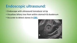 Endoscopic ultrasound:
• Endoscope with ultrasound transducer at tip
• Visualizes biliary tree from within stomach & duodenum
• Accurate to detect stones in CBD.
 