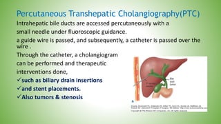Percutaneous Transhepatic Cholangiography(PTC)
Intrahepatic bile ducts are accessed percutaneously with a
small needle under fluoroscopic guidance.
a guide wire is passed, and subsequently, a catheter is passed over the
wire .
Through the catheter, a cholangiogram
can be performed and therapeutic
interventions done,
such as biliary drain insertions
and stent placements.
Also tumors & stenosis
 