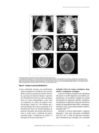11Epidemiol. Serv. Saude,Brasília,27( núm.esp.):e0500001,2018
Maria Aparecida Shikanai-Yasuda e colaboradores
3)	Caso confirmado: paciente com manifestações
clínicas compatíveis com PCM em cuja secreção,
fluido corporal ou material de lesão for observa-
da a presença de elementos fúngicos sugestivos
de P. brasiliensis/P. lutzii em exame micológico
direto ou exame histopatológico, assim como
seu isolamento em cultivo de qualquer mate-
rial biológico (Figura 10). Vale salientar que a
micromorfologia das formas parasitárias de P.
brasiliensis/P. lutzii em material biológico de
pacientes infectados não permite diferenciá-los
entre si. Sendo assim, a definição da espécie
envolvida requer o isolamento em cultivo e a
utilização de técnicas moleculares.56,57
Avaliação crítica de exames sorológicos: diag-
nóstico e seguimento sorológico
As provas sorológicas específicas têm importância
não apenas no auxílio diagnóstico mas também, par-
ticularmente, por permitirem avaliação da resposta
do hospedeiro ao tratamento específico. Atualmente,
são disponíveis em diferentes serviços de referência os
métodos de imunodifusão dupla (IDD), contraimuno-
eletroforese (CIE), ensaio imunoenzimático (ELISA) e
imunoblot (IB).58,59,60
Utilizando-se técnicas padronizadas e antígenos
adequados,61
estes testes apresentam sensibilidade
entre 80 e 95%. O título de anticorpos específicos
anti-P. brasiliensis tem correlação com a gravidade
A
C
E
B
D
F
Fonte:Adaptado de Shikanai-Yasuda MA,Telles Filho F de Q,Mendes RP,Colombo AL,Moretti ML,2006.39
A = radiologia convencional,imagem em“asa de borboleta”.Envolvimento pulmonar bilateral,para-hilar e simétrico,predomínio de lesões alveolares,poupando ápices e terços inferiores;muito
sugestivas de PCM,mas menos frequentes;B = opacidades nodulares e micronodulares difusas e simétricas;C =TC de pulmões com múltiplas cavitações subpleurais.As lesões pulmonares também
podem ser intersticiais do tipo reticular fino ou grosseiro,reticulonodulares e,em menor frequência,do tipo tumoral;D = aumento bilateral de glândulas adrenais;E e F = sistema nervoso central:
imagens de aspecto hipodenso e com realce de contraste em forma de anel,com pequeno efeito de massa.
Figura 8 – Imagens na paracoccidioidomicose
 