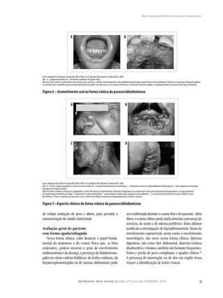 9Epidemiol. Serv. Saude,Brasília,27( núm.esp.):e0500001,2018
Maria Aparecida Shikanai-Yasuda e colaboradores
de relatar avaliação de peso e altura, para permitir a
caracterização do estado nutricional.
Avaliação geral de paciente
com forma aguda/subaguda
Nessa forma clínica, cabe destacar o papel funda-
mental da anamnese e do exame físico que, se bem
realizados, podem mostrar o grau de envolvimento
multissistêmico da doença; a presença de linfadenome-
galia em várias cadeias linfáticas, de lesões cutâneas, da
hepatoesplenomegalia ou de massas abdominais pode
serconfirmadaduranteoexamefísicodopaciente.Além
disso,oexameclínicopodeaindadetectarapresençade
icterícia, de ascite e de edema periférico. Estes últimos
justificamainvestigaçãodehipoalbuminemia.Sinaisde
envolvimento suprarrenal, assim como o envolvimento
neurológico, são raros nessa forma clínica. Queixas
digestivas, tais como dor abdominal, diarreia crônica
disabsortivaevômitos,tambémsãobastantefrequentes.
Febre e perda de peso completam o quadro clínico.40
A presença de tumoração ou de dor em região óssea
requer a identificação de lesões ósseas.
A B
Fonte:Adaptado de Shikanai-Yasuda MA,Telles Filho F de Q,Mendes RP,Colombo AL,Moretti ML,2006.
Obs.:A = gengivoestomatite;B = estomatite moriforme de Aguiar Pupo.
Nota:As lesões podem se apresentar como úlceras rasas,extensas,ou lesões ulcerovegetantes,com pontilhado hemorrágico característico (lesão moriforme).Embora isso seja pouco frequente,podem
se estender para o vestíbulo nasal,causando perfuração de palato e de septo nasal,com sequelas inestésicas e funcionais.Na forma aguda,o comprometimento da mucosa oral é pouco frequente.
Figura 6 – Acometimento oral na forma crônica da paracoccidioidomicose
A B
C D
Fonte:Adaptado de Shikanai-Yasuda MA,Telles Filho F de Q,Mendes RP,Colombo AL,Moretti ML,2006.
Obs.:A = lesões cutâneas papulosas e ulcerocrostosas em face;B = acometimento perioral e mentoniano;C = linfonodos cervicais e submandibulares fistulizados;D = lesão vegetante,com bordas
irregulares em região perianal.
Nota:As lesões cutâneas ocorrem por contiguidade,a partir de mucosas comprometidas,linfonodos fistulizados ou acometimento ósseo,por disseminação hematogênica e,excepcionalmente,
por implantação traumática do fungo.47
Caracterizam-se pelo polimorfismo – ulcerocrostosas,moluscoides,papulosas ou acneiformes –,e se localizam de preferência no polo cefálico e áreas
periorificiais.48
Deve-se registrar que pacientes com a síndrome de Addison apresentam hiperpigmentação cutânea e mucosa.
Figura 7– Aspectos clínicos da forma crônica da paracoccidioidomicose
 
