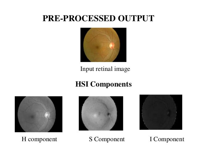 Undergraduate student thesis exudate detection retinal images