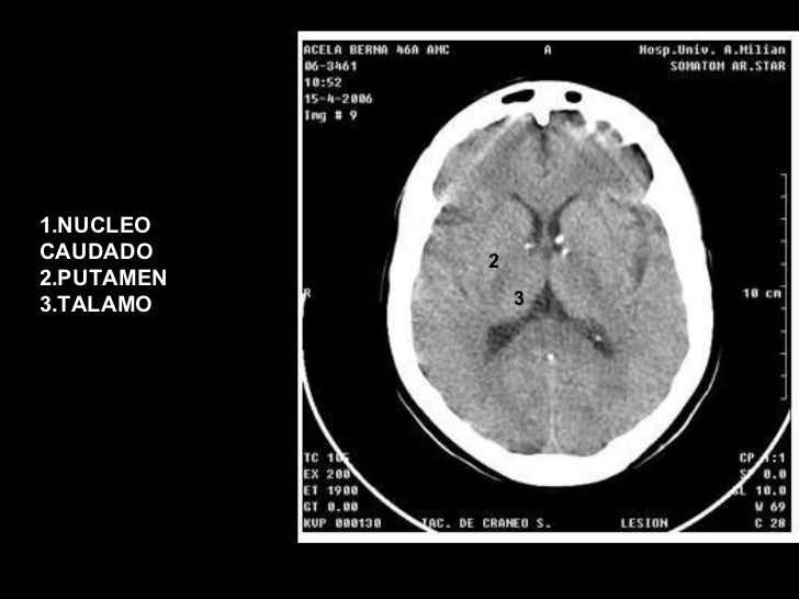22532045 anatomia-cerebral-por-tomografia-axial