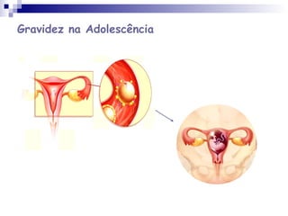 Gravidez na Adolescência
 