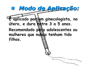  Modo de Aplicação:Modo de Aplicação:
• É aplicado por um ginecologista, no
útero, e dura entre 3 a 5 anos.
• Recomendado para adolescentes ou
mulheres que nunca tenham tido
filhos.
 