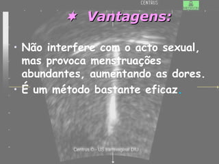  Vantagens:Vantagens:
• Não interfere com o acto sexual,
mas provoca menstruações
abundantes, aumentando as dores.
• É um método bastante eficaz.
 