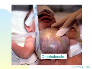 Jump to first page
Omphalocele
 