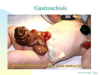 Jump to first page
Gastroschisis
 