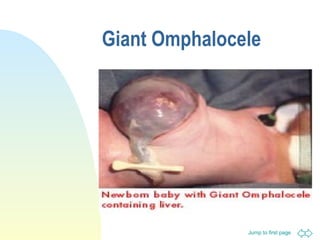 Jump to first page
Giant Omphalocele
 