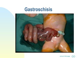 Jump to first page
Gastroschisis
 