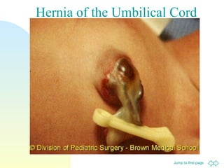 Jump to first page
Hernia of the Umbilical Cord
 