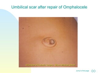 Jump to first page
Umbilical scar after repair of Omphalocele
 