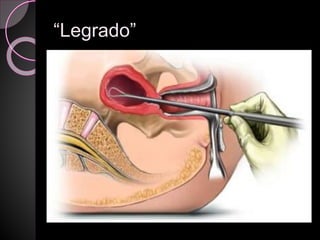 “Legrado”
 