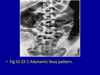 • Fig GI 22-1 Adynamic ileus pattern.
 