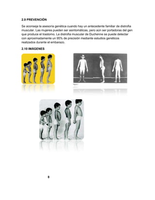 2.9 PREVENCIÓN
Se aconseja la asesoría genética cuando hay un antecedente familiar de distrofia
muscular. Las mujeres pueden ser asintomáticas, pero aún ser portadoras del gen
que produce el trastorno. La distrofia muscular de Duchenne se puede detectar
con aproximadamente un 95% de precisión mediante estudios genéticos
realizados durante el embarazo.
2.10 IMÁGENES
8
 