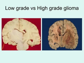 Low grade vs High grade glioma
 