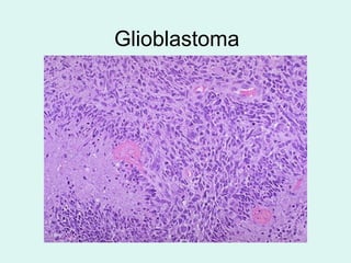 Glioblastoma
 
