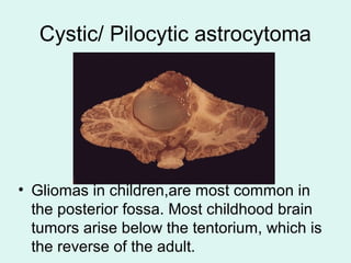 Cystic/ Pilocytic astrocytoma
• Gliomas in children,are most common in
the posterior fossa. Most childhood brain
tumors arise below the tentorium, which is
the reverse of the adult.
 