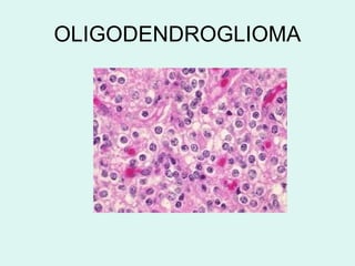 OLIGODENDROGLIOMA
 