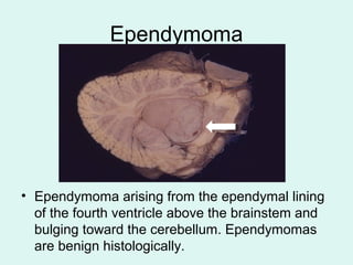 Ependymoma
• Ependymoma arising from the ependymal lining
of the fourth ventricle above the brainstem and
bulging toward the cerebellum. Ependymomas
are benign histologically.
 