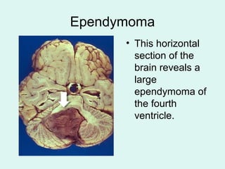 Ependymoma
• This horizontal
section of the
brain reveals a
large
ependymoma of
the fourth
ventricle.
 