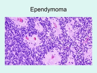 Ependymoma
 