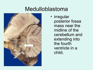 Medulloblastoma
• irregular
posterior fossa
mass near the
midline of the
cerebellum and
extending into
the fourth
ventricle in a
child.
 