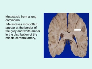 Metastasis from a lung
carcinoma.
Metastases most often
appear at the border of
the grey and white matter
in the distribution of the
middle cerebral artery,
 