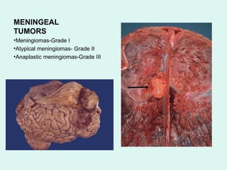 MENINGEAL
TUMORS
•Meningiomas-Grade I
•Atypical meningiomas- Grade II
•Anaplastic meningiomas-Grade III
 