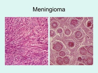 Meningioma
 