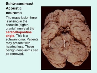 Schwaanomas/
Acoustic
neuroma
The mass lesion here
is arising in the
acoustic (eighth
cranial) nerve at the
cerebellopontine
angle. This is a
schwannoma. Patients
may present with
hearing loss. These
benign neoplasms can
be removed.
 